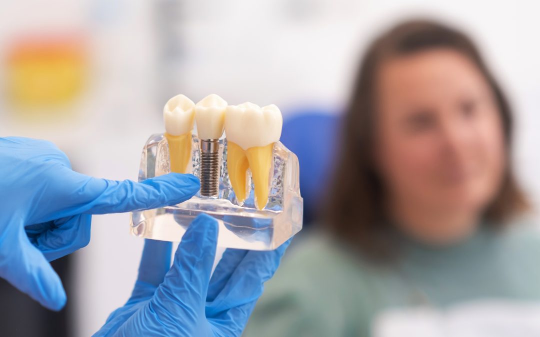 Types of Dental Implants in Cancun: Which One Suits You The Best?