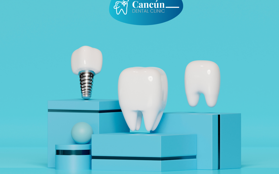 Same-Day Dental Implants: Immediate-Load vs Two-Stage – Who Qualifies?