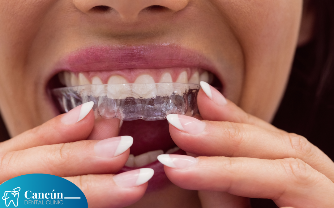 The Importance of Night Guard after Dental Implants